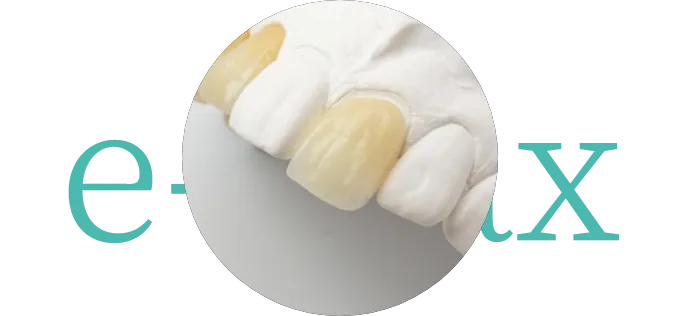 天然歯に近い白さと適度な強度 オールセラミック（e-max）